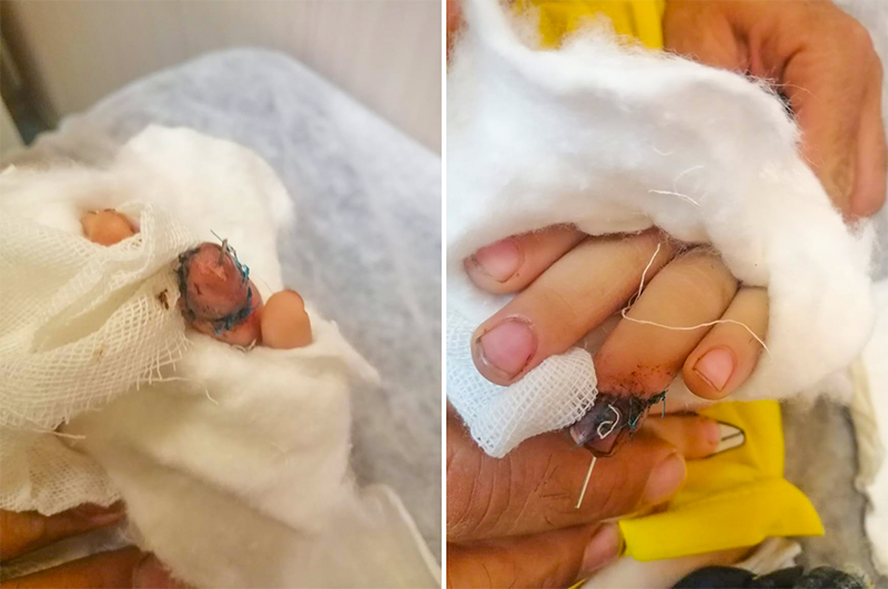 پیوند انگشت 2